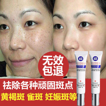 Hydroquinone cream decomposes melanin and freckle with the same effect.
