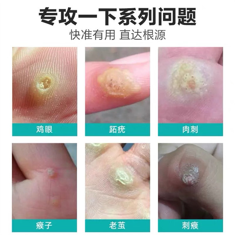 Chicken Eyes Foot Soles Hand Reflexology Old Cocoon #-Taobao