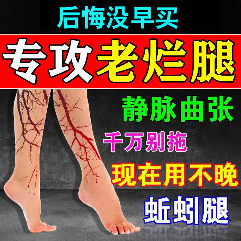 Special treatment instrument Cream for Spero Varicose Veins for Varicose Veins, Ointment Appliquel for Cold Compress Gel for External Divinity Elastic Socks