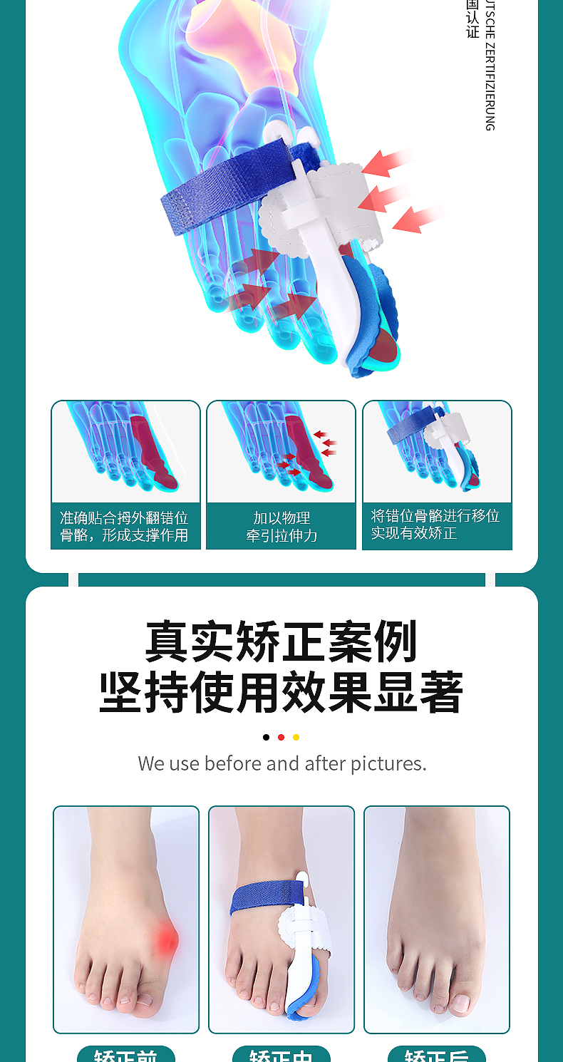 卓辰 脚趾矫正器 天猫优惠券折后￥19.8包邮（￥25.8-6）