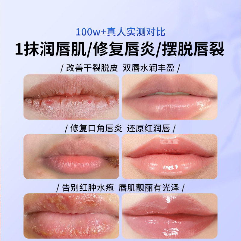 唇部型医用退热凝胶唇膏:守护你的唇部健康,告别干裂脱皮!-导诊台-淘宝百科网