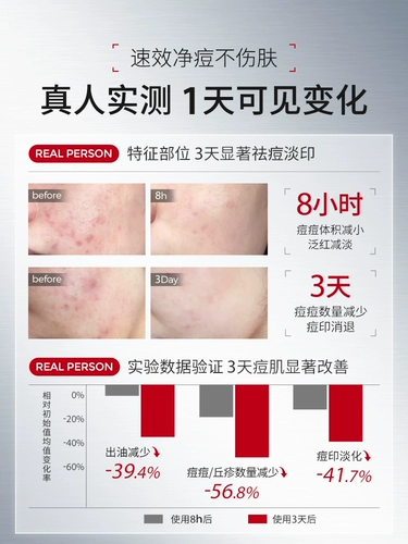 Ning прыщи отмечает слабые следы от прыщей, прыщи, прыщи, шрамы от прыщей, прыщи, крем от прыщей, мужские и женские подлинные