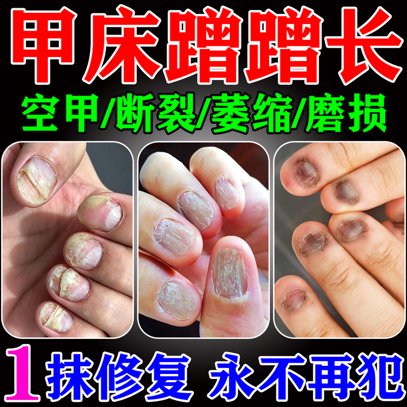 Nail Bed Repair Growth Solution, Nail Care Oil, Nourishing Nails, Thickening, Vertical Lines, Hollow Nails, Biting, Shrinking, Damaged Nails, Maintenance Nail Bed Repair Growth Solution, Nail Care Oil, Nourishing Nails, Thickening, Vertical Lines, Hollow Nails, Biting, Shrinking, Damaged Nails, Maintenance