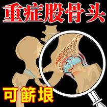 Femoral head ischemic necrosis special ointment joint pain patella sacroiliac hip physical therapy cold compress rehabilitation device traditional Chinese medicine paste