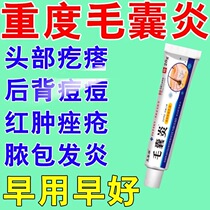 (Folliculitis Cream) scalp face back chest hair follicles acne pustules acne skin itching suppresses bacterial itching