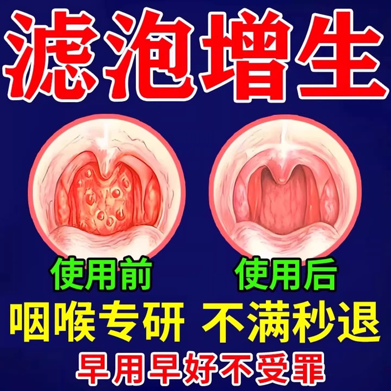 As Soon as You Spray, It Helps】 Lymphoid Folliculitis in the Throat, Sore Throat, Lymphatic Follicles, Dry and Itchy Tongue Root Follicles, Sensation of Foreign Body in the Throat
