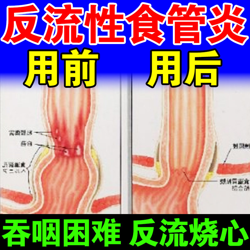 Gastroesophageal anti-flow Traditional Chinese medicine post-cure esophagitis conditioning gastric bile anti-flow esophagitis anti-acid burning heart and stomach tea