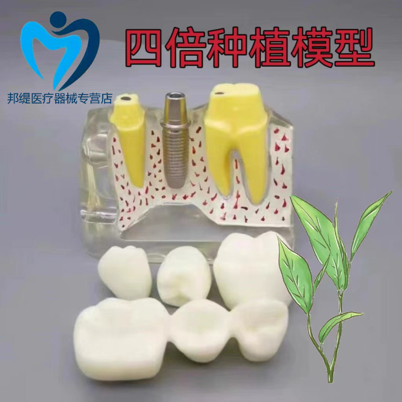 丞诚品牌四倍种植牙齿放大模型 牙科教学种植演示水晶工具