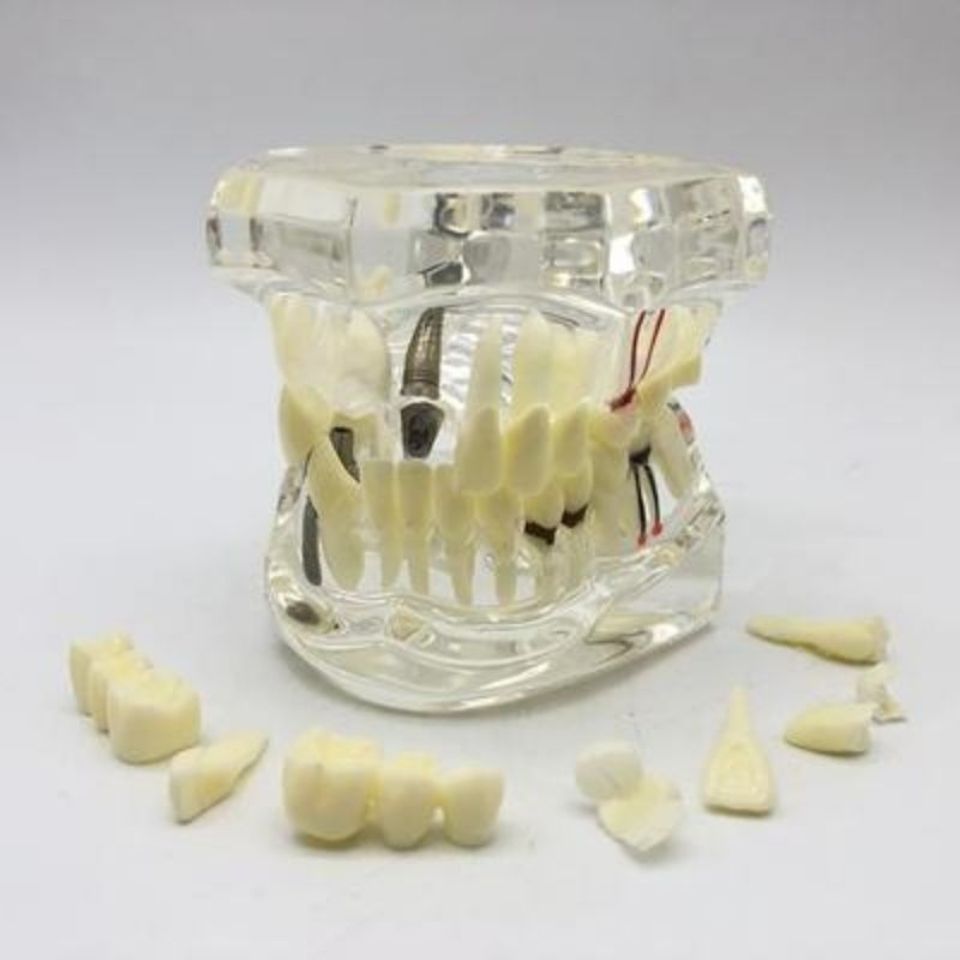 牙科口腔水晶连桥可拆卸病理牙模型 活动种植牙模型