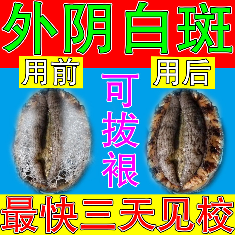 How to do the following itching treatment of vulvar leukoplakia