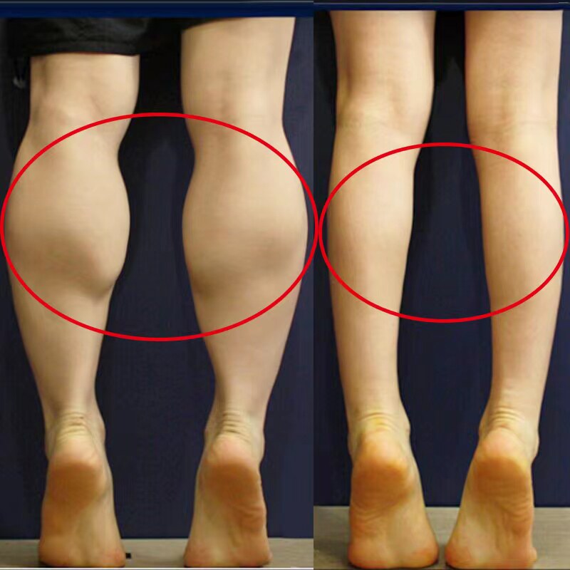 (Recommended by Xiaohongshu) No traces left on the body, no more embarrassment to wear short skirts in summer, buy 3 get 2 free