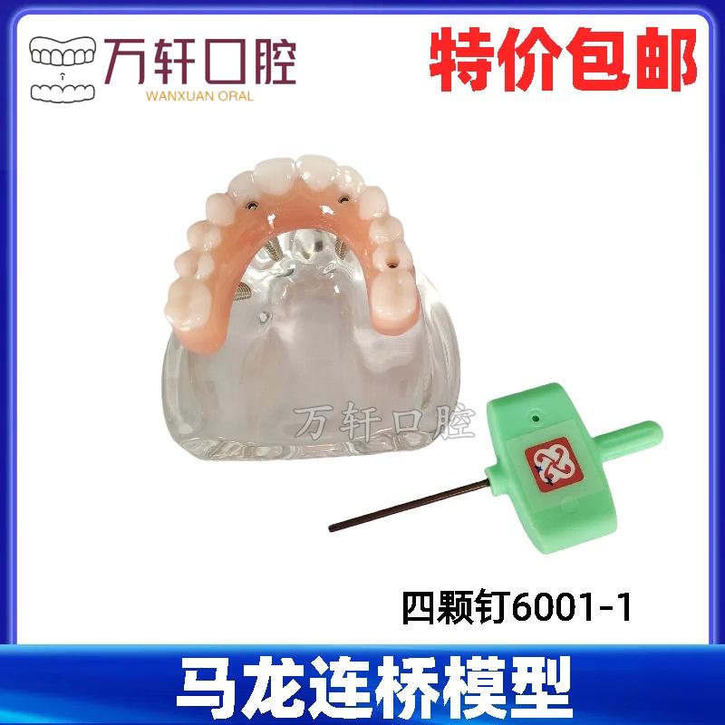 牙科口腔模型马龙连桥义齿修复种植牙齿仿真演示模拟教学医患交流
