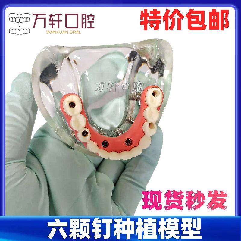 牙科模型教学演示器材 马龙连桥义齿模型 六颗钉种植牙仿真教学模型