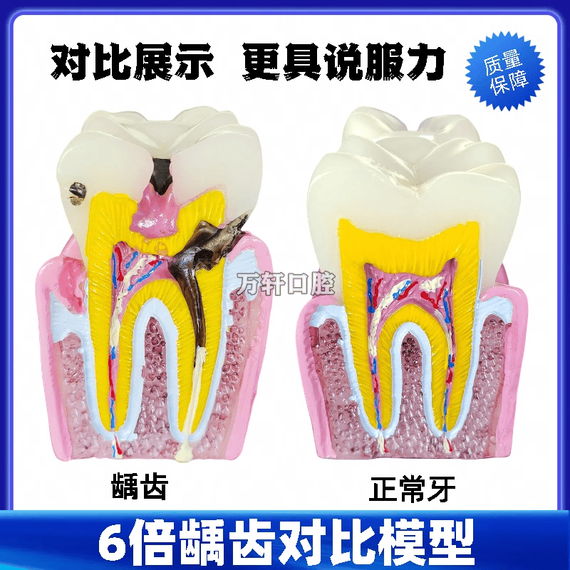 牙科 口腔6倍龋齿对比模型 蛀牙龋齿演变过程 医患沟通教学 包邮
