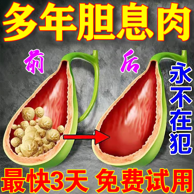 Gallbladder Polyps Special Medicine Treatment Single Hair Multiple Calculus of Petrochemical Stone Plaststone Import Special Effects Traditional Chinese Medicine Post SX-Taobao