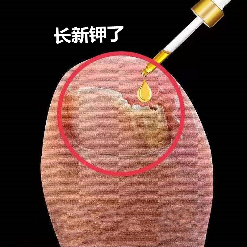 Xiaohongshu recommends bad nails to become good nail artifact, enjoy a good nail life, repair fingers and toes and become better