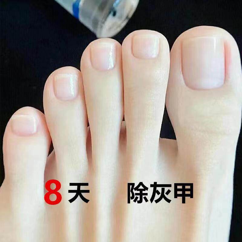 The effect is too good (return if not clean) drop a drop of ash potassium clean bad nails become good potassium enjoy good potassium buy 2 get 1 free