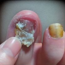 (Watson’s hot sale) One drop of it inhibits bacteria without removing nails removes 99% of gray potassium fungi and guarantees refund if ineffective.