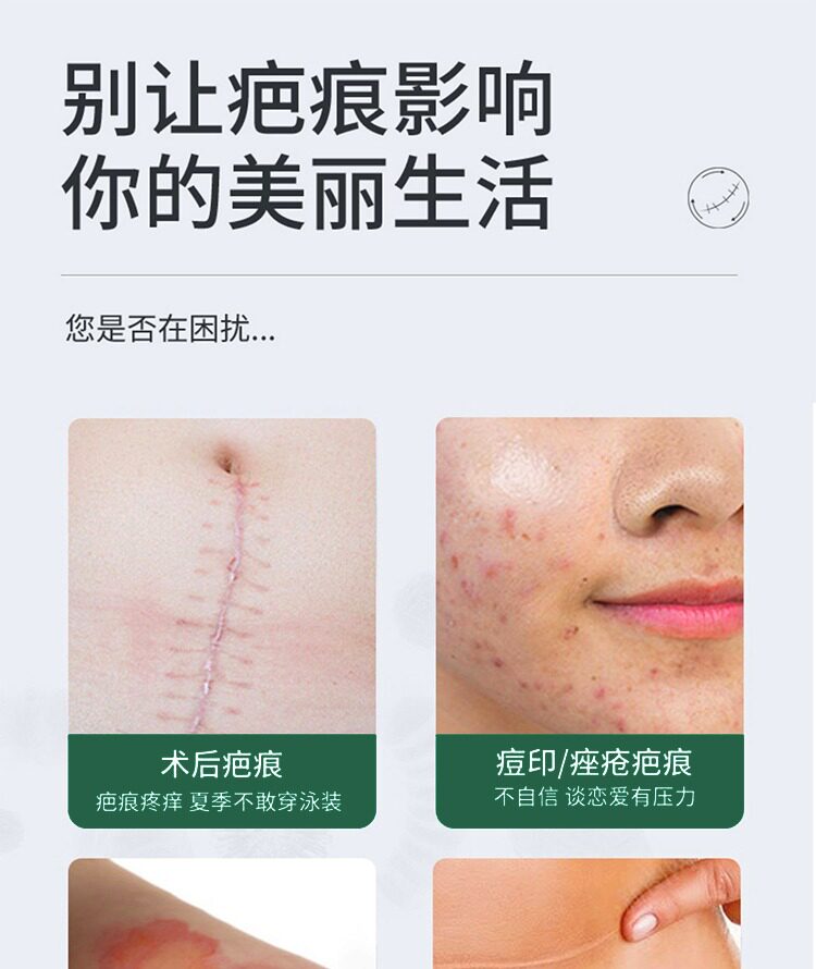 Убрать растяжки массажер 【日本爆款热卖】日系疤痕滚珠修复剖腹产增生凹凸疤痕全身 OTHER