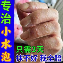 Hands long water Blistering Rubella Cream Fingers Ups A Blistering Peel Dry Skin Allergy Water Bubble Hands Itch Small Blisters
