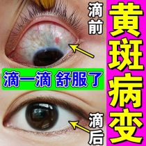 Yellowing of the whites of the eyes clear removal of yellowish turbidity yellowing of the eyeballs blurred vision red bloodshot eyes macular degeneration eye drops