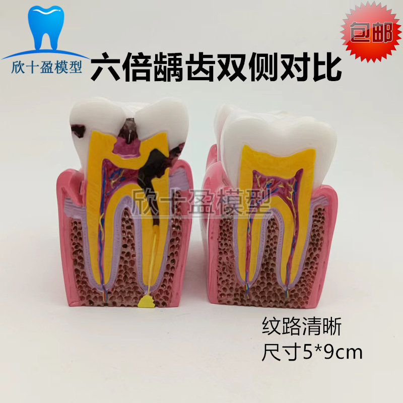 牙科 口腔6倍龋齿对比模型 蛀牙龋坏演变过程 医患教学沟通 包邮