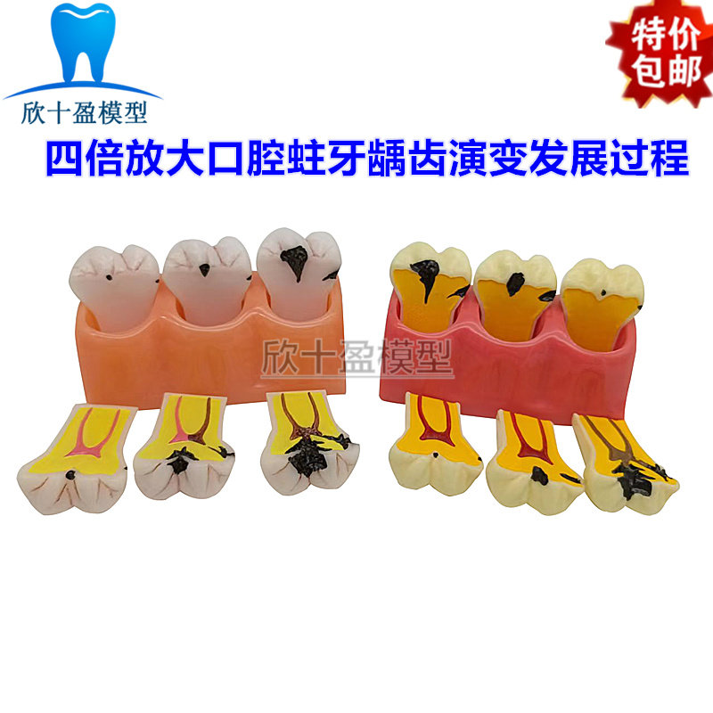 牙科口腔牙齿龋齿演变模型 四倍龋齿分解模型 患者沟通模型包邮