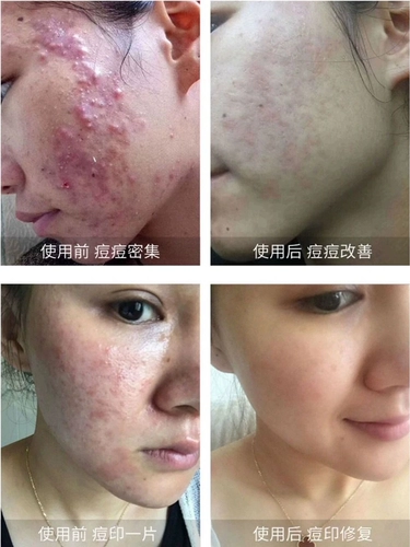 Какими лекарственными лимфатическими узлами являются прыщи на поверхности прыщей на лице неоднократно на лице