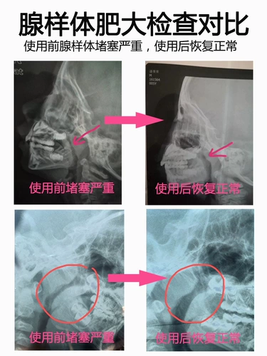 Детские дыхательные освежающие ортезы для сна от заложенности носа