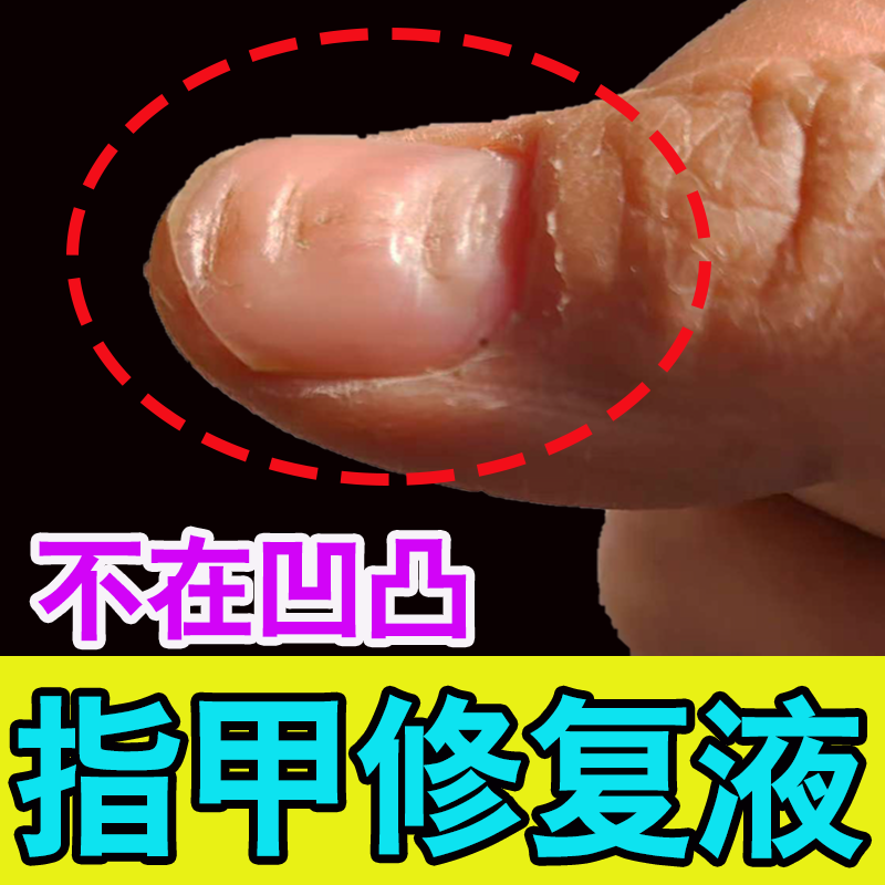 Nail Repair Solution for Uneven Nail Surfaces, Dents, Pits, Thick Nails, Nail Biting, Nail Recession, Nail Regrowth Solution