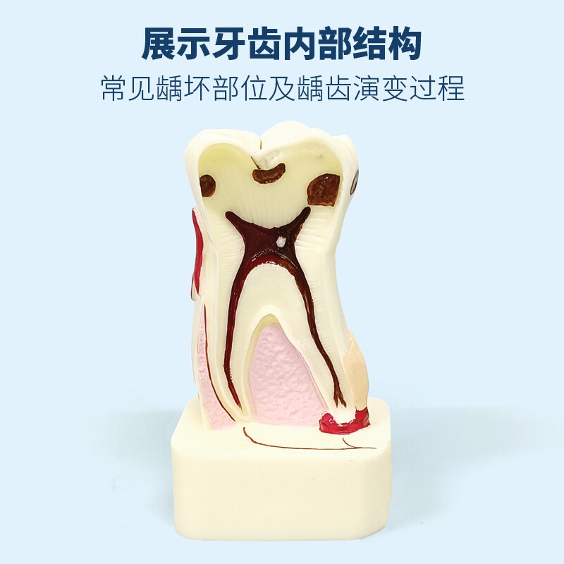牙齿模型口腔教学龋齿龋坏医患沟通展示练习四倍牙齿综合病模型