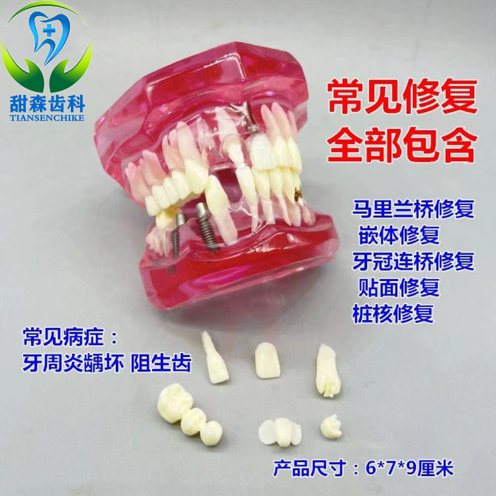 牙科种植模型口腔病理模型牙齿综合教学模型连桥病理贴面修复粉色