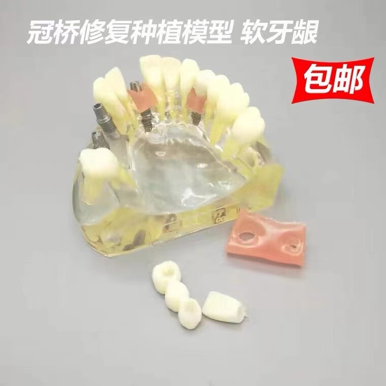 牙科半口种植修复模型新款医患沟通种植钉软牙龈冠桥解刨结构可拆