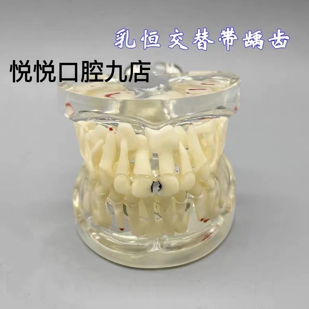牙科 乳牙交替龋齿模型 儿童水晶病理 医患沟通 口腔讲解示范模型