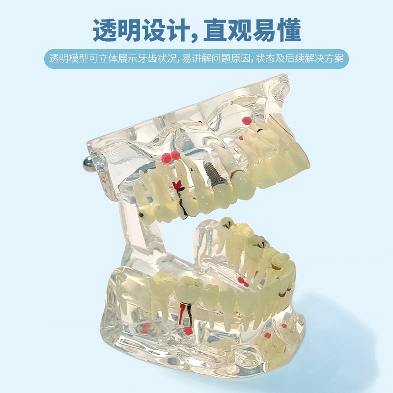 牙科综合病理演示模型仿真牙模医患病理演示模拟口腔牙科教学模型