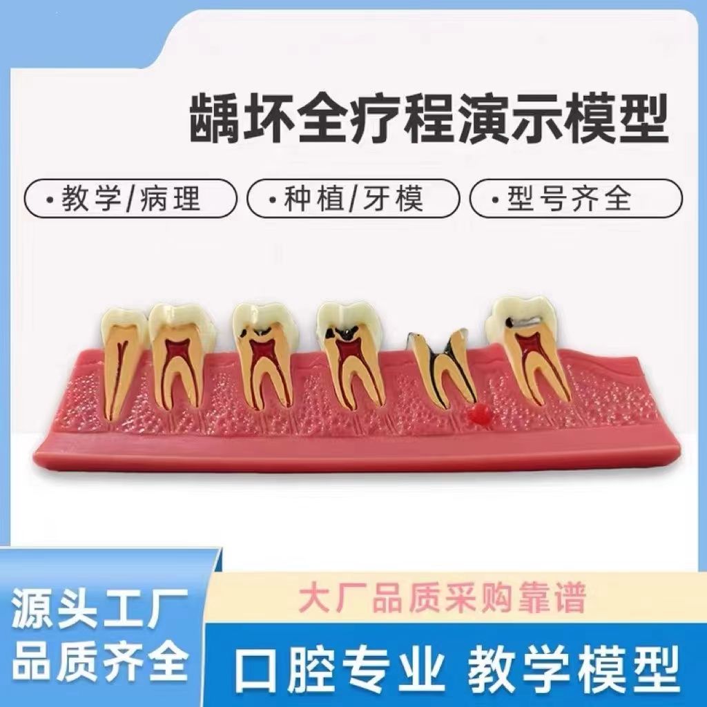 龋坏全疗程演示模型可拆卸树脂教具医用考试专用口腔模型牙齿模型