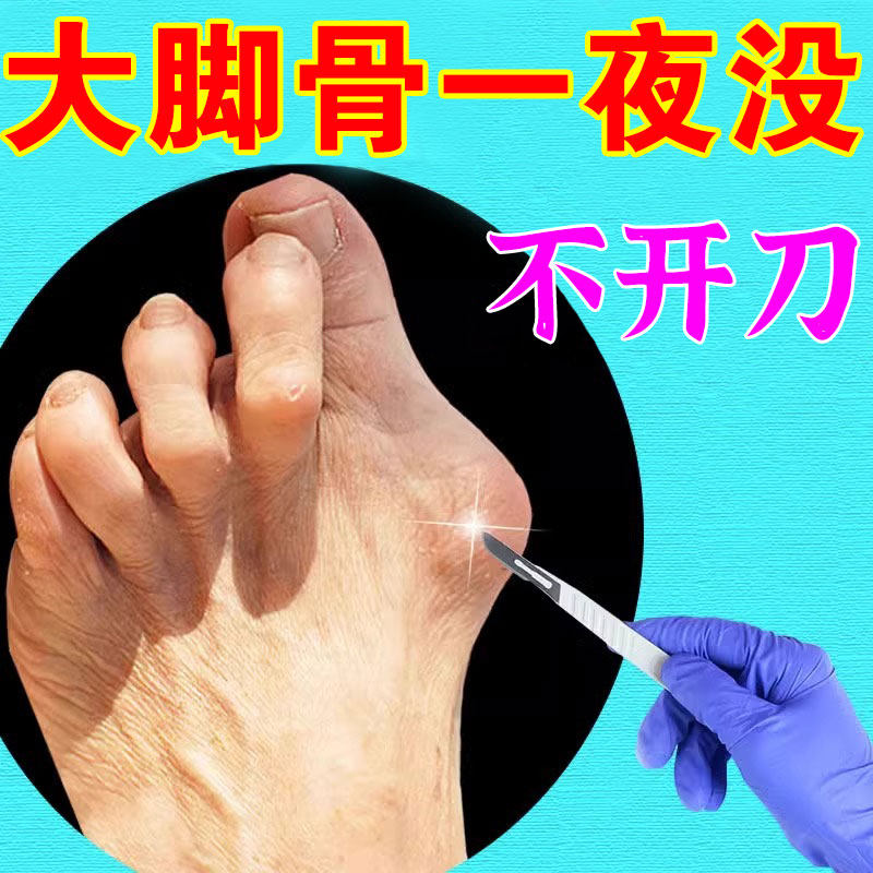 (Morning with early use) Large footed bone toe overlap special paste with hallux valgus deity Thumb Valgus Correction Therapy Sticker-Taobao