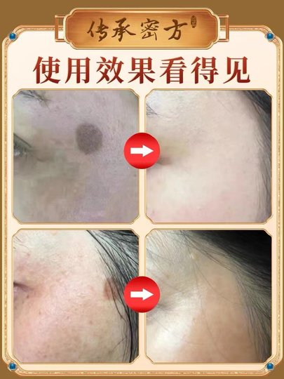 Powerful Removal of Age Spots, Special Cream for Hands and Face to Remove Melanin, Genuine Ointment for Removing Chloasma for the Elderly