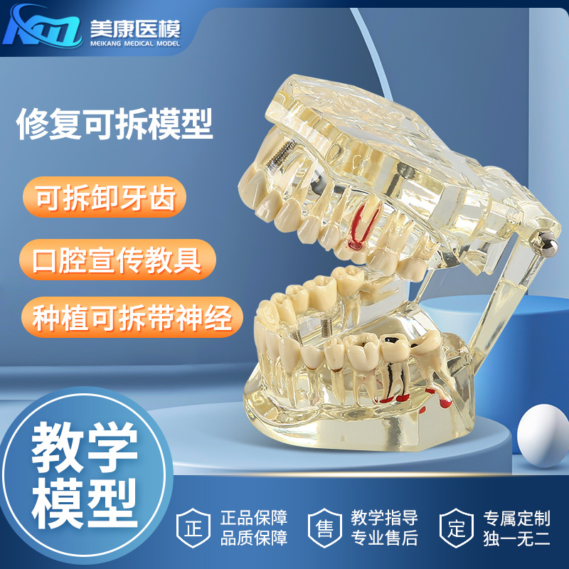 Dental Restoration Model, Oral Pathology, Doctor-Patient Communication Teaching, Comprehensive Restoration with Nerves, Removable Dental Model