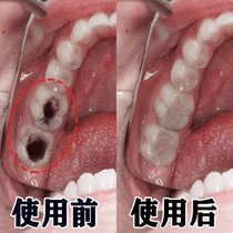 (Recommended by Xiaohongshu) Prevent cavities bid farewell to cavities black holes in teeth repair cavities due to cavities