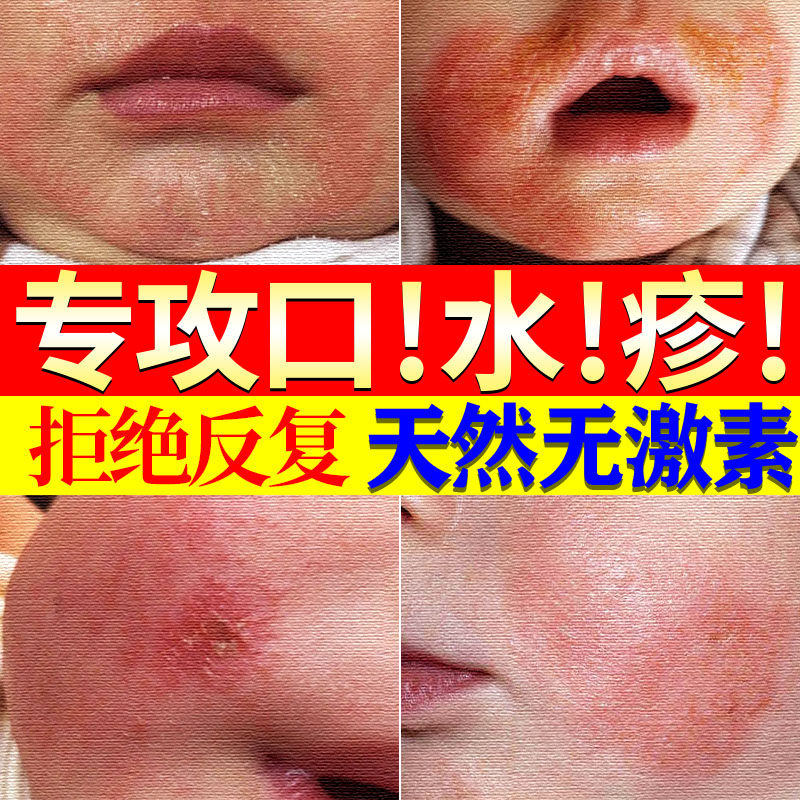 Saliva rash ointment wet heat rash baby baby cream special artifact repair cream non-aisongda bookstore Vaseline