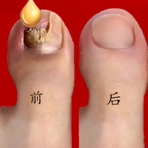 (Watson’s hot sale) One drop of it inhibits bacteria without removing nails removes 99% of gray potassium fungi and guarantees refund if ineffective.
