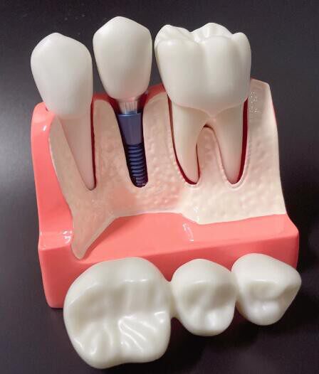 种植牙口腔牙模型 4倍种植解说模型 展示 Dental implant model