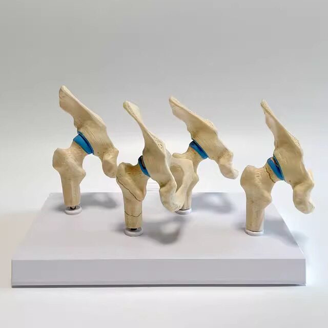 髋关节模型股骨头软骨损伤程度股骨颈骨折髋臼病理骨科医药促销礼