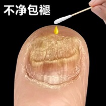 (Küchens hot selling) Drop a drop of bacteriostatic no-nail to remove 99% ash potassium fungus invalid packet withdrawal  