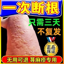 Urticaria allergy antipruritic special medicine for acute and chronic wheal urticaria nemesis skin itching ointment