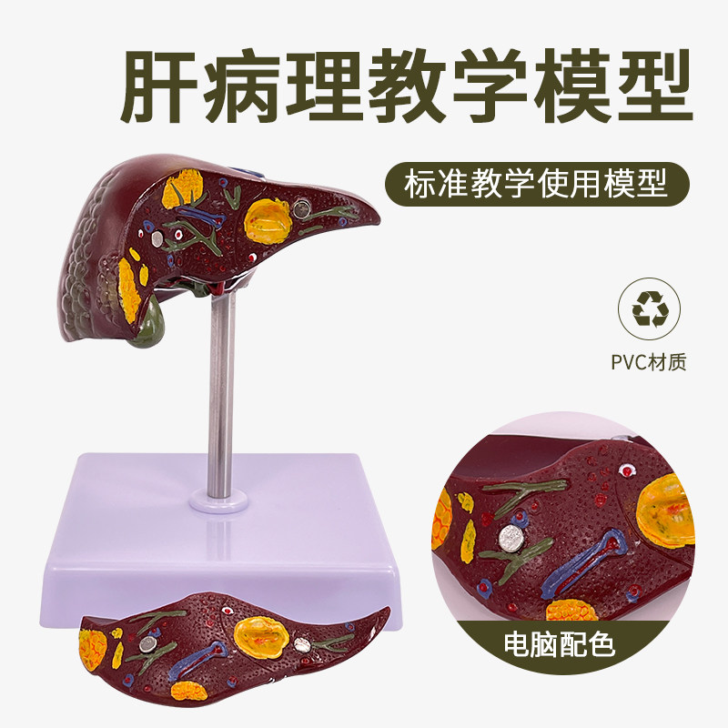 肝脏病理 病理肝模型 胆结石模型 医用 脂肪肝演示 病态胆囊解剖