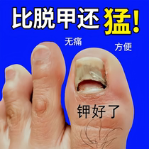 (Watsons hot sale) One drop of it inhibits bacteria without removing nails and removes 99% of gray potassium fungi. The effect is great.