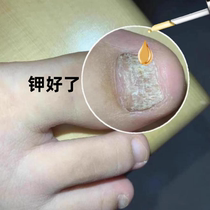 (Tongrentang hot sale) A drop of it can inhibit bacteria without removing nails and remove 99% of gray potassium fungi. If invalid return guarantee