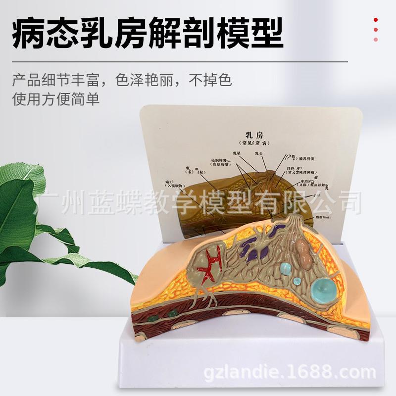 乳房病理模型 乳房病变模型 乳房模型 乳房解剖模型 哺乳培训模型